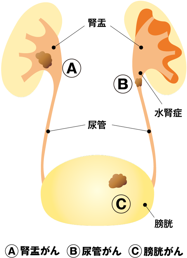 膀胱がん、腎盂がん、尿管がん、尿路上皮がん