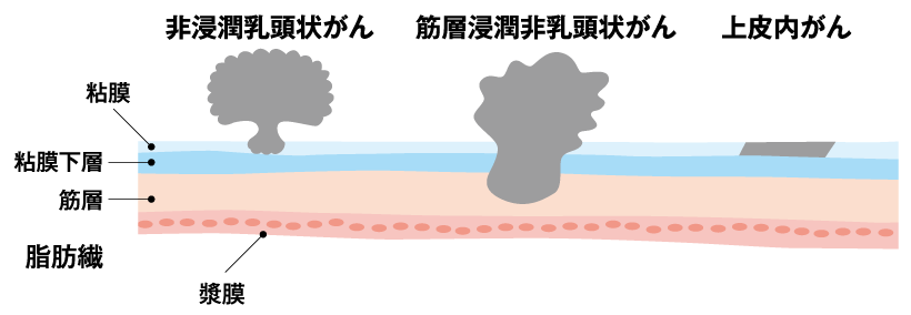 膀胱がん説明画像